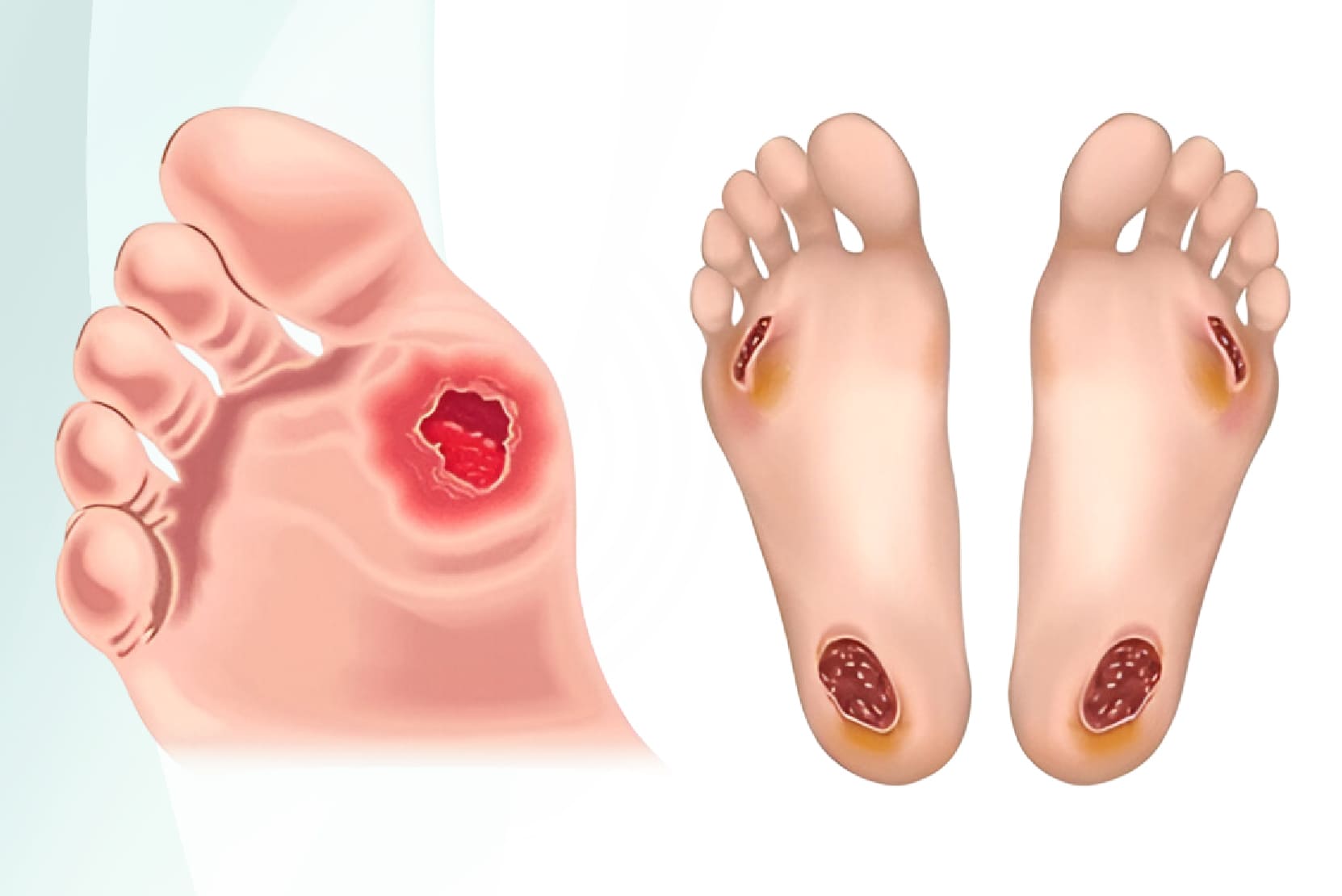 Diabetic Foot